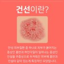건선피부 청대밤 크림 사용 후기(내돈내산)