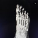 King 편의점 | [발등 뼈 골절/발목 인대 봉합술 수술 및 입원기] #1 엄살King 울보 King