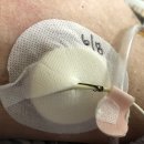 제일메딕스약품 | 드레싱제품]캐스드레싱-집에서 배액관 관리하기(PTBD, JP, PCN등)