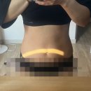 뱃살지방분해주사 복부 바디라인 변화 후기