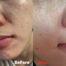 율림교로 | 조엘랑더마랩 슈퍼젝션 후기: 얇고 예민한 피부, 기미·잡티 고민 해결!