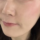 서현메디칼 | 분당 서현 민감성 속건조 피부 개선 후기ㅣ줄기세포 엑소좀 앰플 공기침투 스킨부스터ㅣ유온리에스테틱