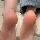 내성지구대 | 울산 무좀발톱 발각질 문제성 발관리엔 레푸스 울산삼산점