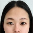 누브의원 네이버블로그
