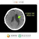 치매 및 위험요인(김수환 기자) 이미지