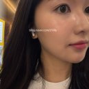 강남색소치료 코어레이저 피코토닝 제네시스 루비레이져 뷰레인 후기