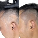 중년과새싹 | 전주두피페인팅 잘하는곳 가격 효과 후기 3가지 한방정리