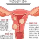 자궁근종 원인 방법 이미지