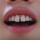 고석호치과의원 | 치과의사도 한 쎄라필름 유튜버 오대리Oderi님 리얼 후기! by.2D치과(투디치과)