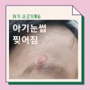 수원 명성형외과 레이저 후 4일 경과 상태