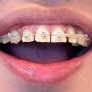 늘좋은치과의원 | 돌출입 교정 반년 후기 수유역 치과 가바교정치과