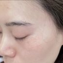 기미딱지패치 장희빈미안법 비교 사용 후기