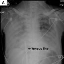 VA type ECMO -＞ VV type ECMO 전환시 발생한 황당한 경우,,,case report,,,댓글 많이,,, 이미지