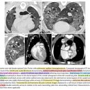 Canine PVOD and PCH ; Pulmonary Arterial Hypertension 환자에서의 새로운 DDx 이미지