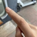 록스라텍스 | 손 습진?건선?5일만에 치료 후기