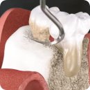 서울뿌리깊은치과의원 | [ 마곡치과_잇몸치료 시리즈3 ] 잇몸 깊숙이 파고드는 '치은박리소파술'이 필요한 순간