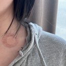 서울아산병원 갑상선암 세침검사 후기ㅣ 갑상선암 일기 #2