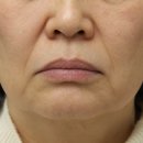 유투성형외과의원 | 얼굴 실리프팅 유투성형외과 | 팔자주름, 인상까지 바꿉니다 | 콜라겐 실리프팅 후기