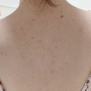 ㈜세정티 | 등드름 피부케어 미끈거림 없이 강력한 세정 해피바스 딥클린 아크네 바디워시 강추