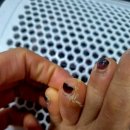 동성프라자 | 굳은살 통증 때문에 찾은 본네일, 동성제약 풀리메디 관리 경험