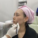 제이디피부과의원 | 강남제이디의원 - 나노실리프팅+프롤로인대리프팅주사 일주일 후기