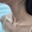 목은한의원 | 서면편평사마귀제거 한의원 내돈내산 후기, 목 전체 전후 변화 기록