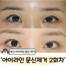 안**-2 | 부산아이라인문신제거 안아픈곳 2회차 후기