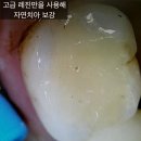 연세林(림)치과의원 | 금 인레이 크랙? 금 인레이 후 어금니 금감 있었지만 성공적으로 크라운 치료 해 드린 후기! [공덕역 충치]