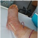 기웅목장 | 발목골절 비골 수술 후 입원 4박5일 중 3일차 후기 / 봉합유지기로 봉합 / 기브스 방수커버로 샤워 해결 ^^