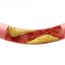 고지혈증의 이해와 관리 이미지