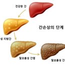 알코올성 간 질환[alcoholic liver disease] 이미지