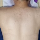 A1335 | [ 부산 ] 부산 사하구 다대동 등드름 &amp; 등 착색 케어 " 설레임에스테틱 "