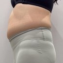 (주)고리 | 교대역지방흡입 하는 김에 같이 받아본 허파고리후기