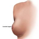 Inverted nipple: Cosmetic problem or medical concern? 이미지