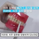 [클리어치과] 워터픽(구강세정기) 공동구매에 관하여 공지드립니다.^^ 이미지