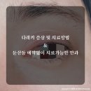 세려메디칼 | 둔산동 예약 없이 진료 가능 안과 &amp; 다래끼 치료 후기!
