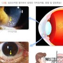 포도막염 증세 및 , 홍채염 (시야흐림, 눈부심현상, 안구통증, 오른쪽 왼쪽 눈통증) 이미지