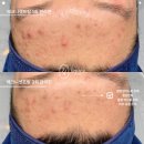 상도사 메디칼 | 포항여드름흉터,압출관리 르주비아에스테틱 솔직후기