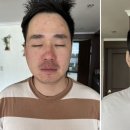만성인셀덤
