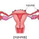 생리통심한이유 자궁내막증 초기일 수도 있습니다. 이미지