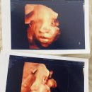 정다 | 분만후기: 송파고은빛 산부인과에서의 유도분만 후기 (W 정다와원장님)