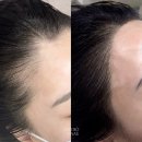 인천헤어라인반영구 후기ㅣ인천헤어라인교정 후기ㅣ 스튜디오다애