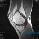 무릎연골파열로 인한 무릎통증~무릎연골수술 이미지