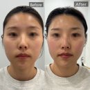 프로메디칼 | 대구 탄력관리 리프팅 셀룩스프로 1회관리만으로 효과보고 온 아미뷰티센터 후기