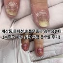 메디헬스(주) | 계산동 문제성 손톱무좀은 김수정뷰티(수족구 이후 심한 변형 온 7살 케어 후기)