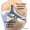 내측측부인대 손상에 대하여 이미지