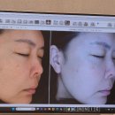 (주)텐이얼즈애프터 | 대화동피부과에서 고현정리프팅 텐써마 하고 온 40대 후기