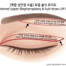필리프트성형외과의원 | 수원 상커풀, 한 번에 해결하는 중년 눈성형