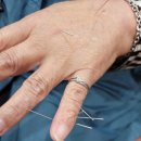 건강 지킴이 수지침 이미지