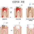 치과 신경 기간 및 시간 통증 과정 치아 신경 후 통증 이미지